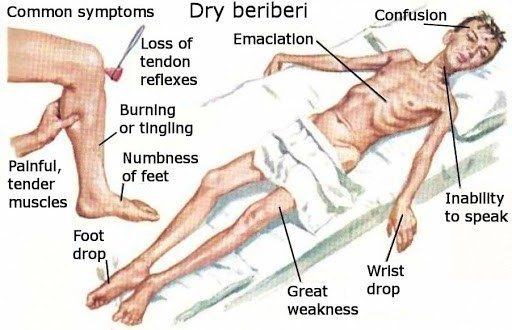 Thiamine Deficiency Rehab Guide