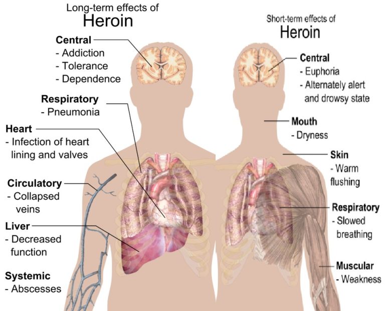 Heroin addiction and treatment rehab guide