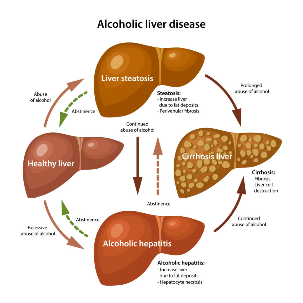 liver effects of drinking alcohol every day