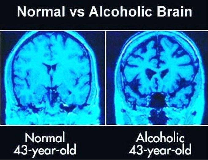 Brain scan comparison showing normal vs alcoholic brain - alcohol and depression
