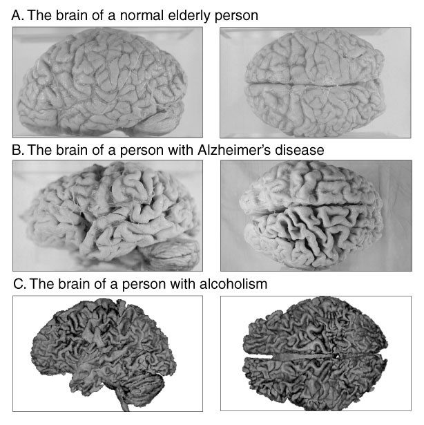 Image comparing alcohol brain damage to healthy and affected brains.