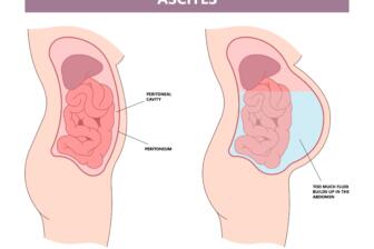 Diagram showing ascites causes, comparing normal and ascites-affected abdomen.
