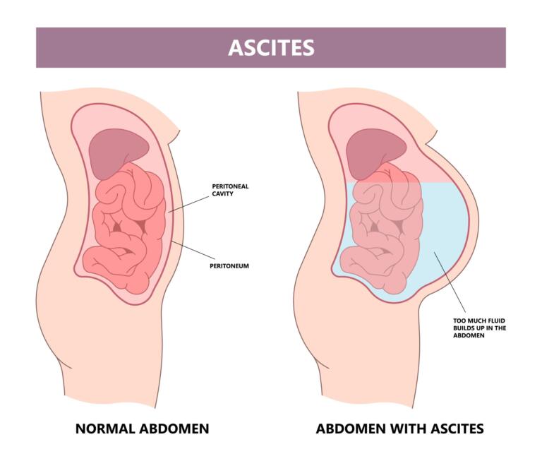 Diagram showing ascites causes, comparing normal and ascites-affected abdomen.
