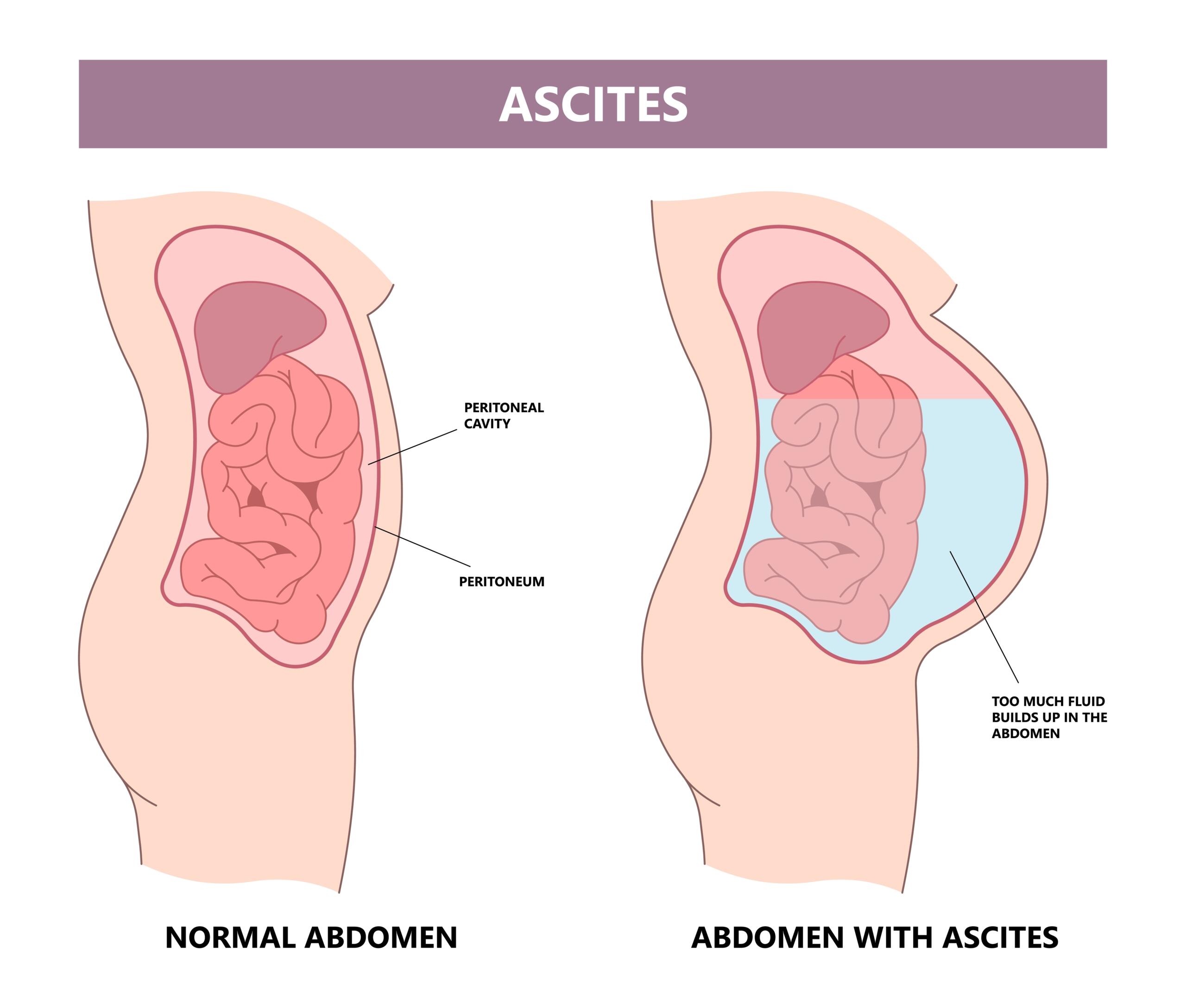 Diagram showing ascites causes, comparing normal and ascites-affected abdomen.