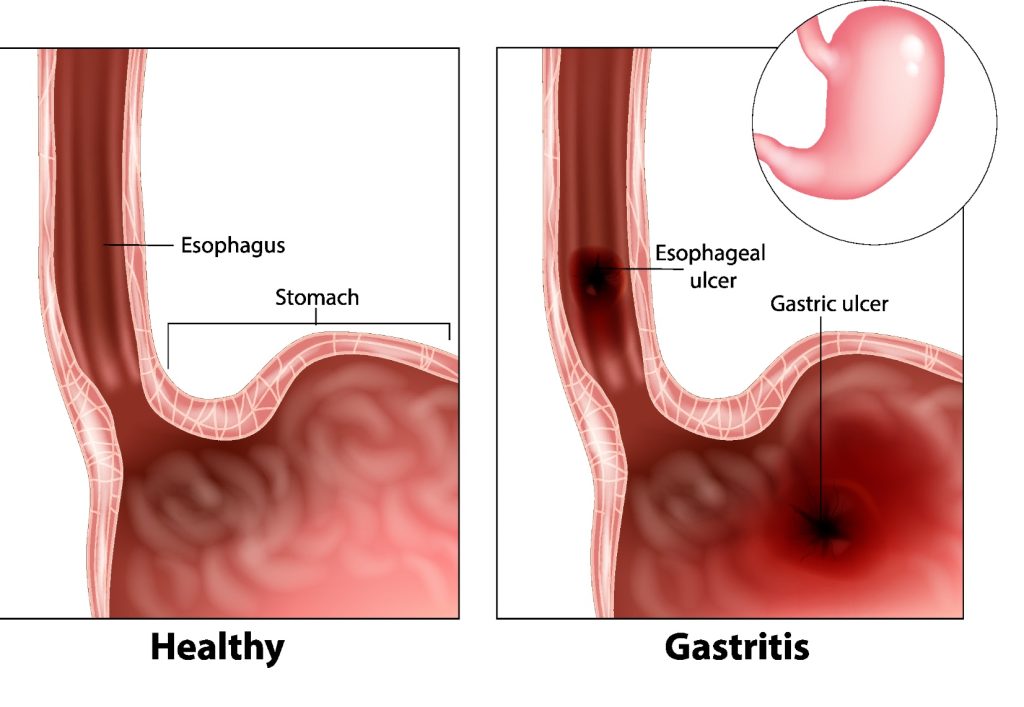 Image showing healthy vs. ulcerated stomach, linked to black vomit after drinking.