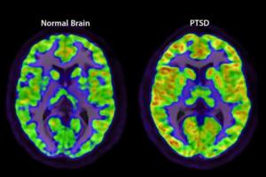 Brain scans comparing normal and PTSD-affected brain patterns in recovery