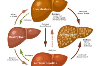 Diagram showing liver conditions: healthy, steatosis, hepatitis, cirrhosis.